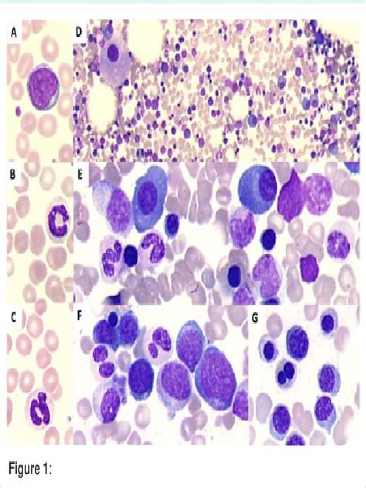 Is myelodysplastic syndrome related to multiple myeloma?