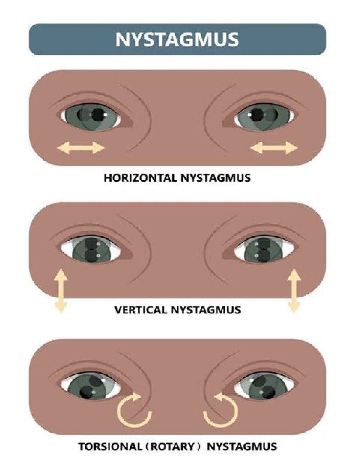 Is nystagmus bad for your eyes?